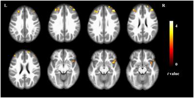 The relationship between processing speed and remodeling spatial patterns of intrinsic brain activity in the elderly with different sleep duration